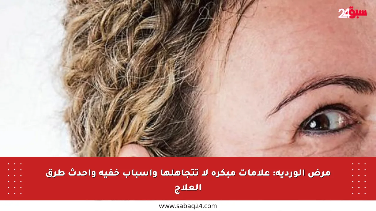 مرض الوردية: علامات مبكرة لا تتجاهلها وأسباب خفية وأحدث طرق العلاج